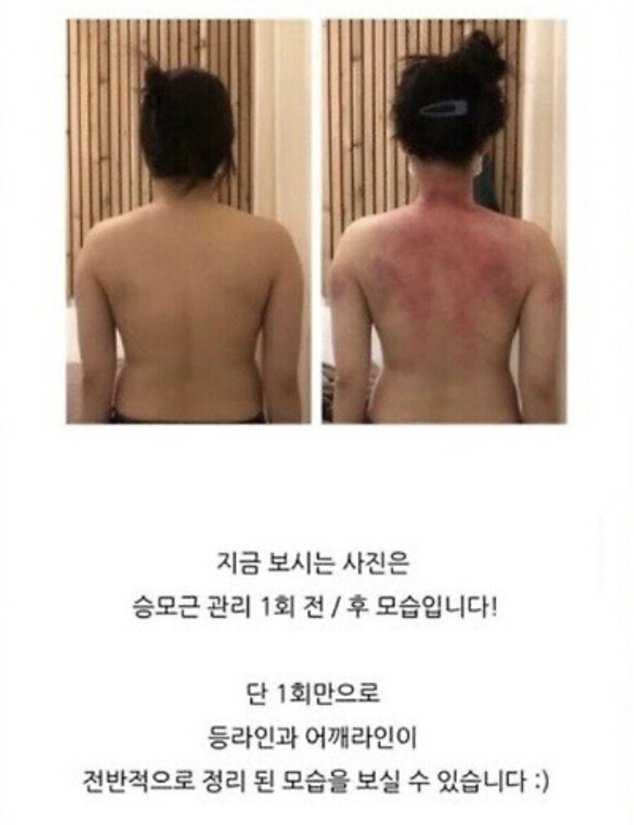 승모근이 단 1회만에 교정이 된 이유_1.jpg