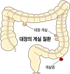 지금 내가 걸린 게실염이라는 것은 말야..._1.jpg
