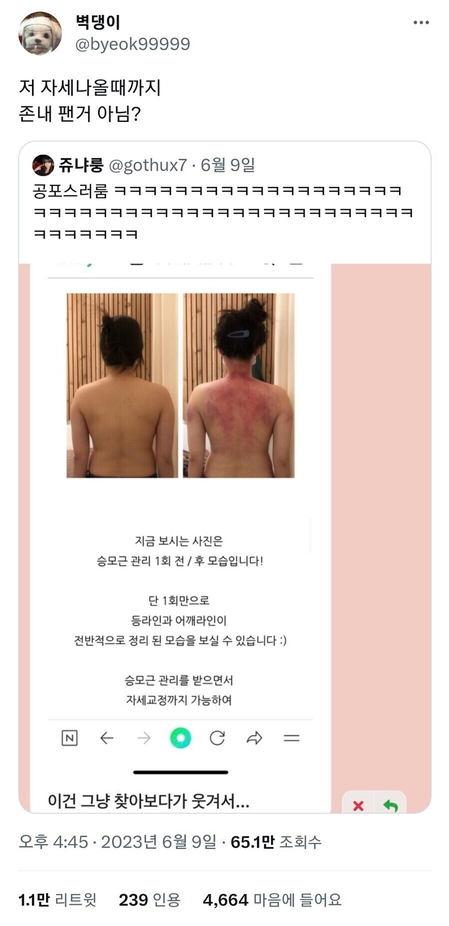 단 1회 시술로 등과 어깨라인을 교정해 드립니다!.jpg_1.jpg