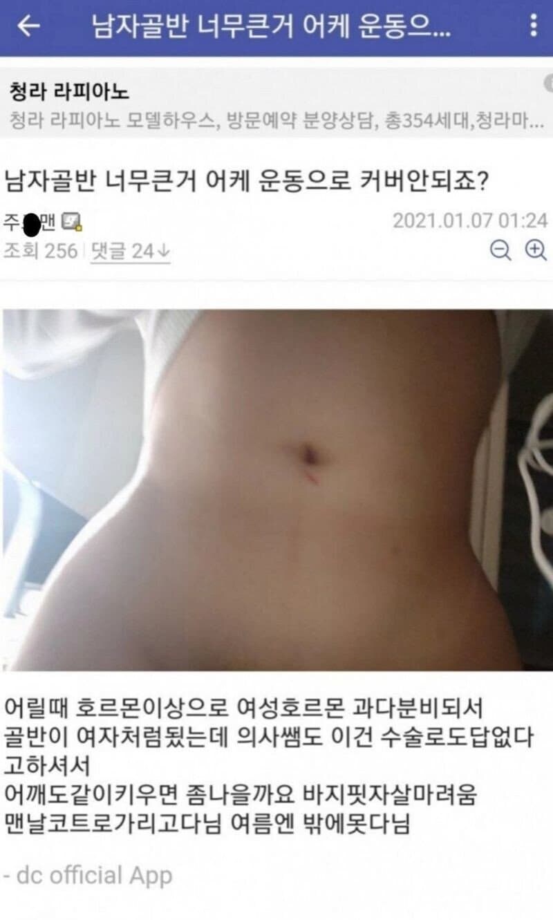 여성호르몬 이상으로 여자골반이 생긴 남자_1.jpg