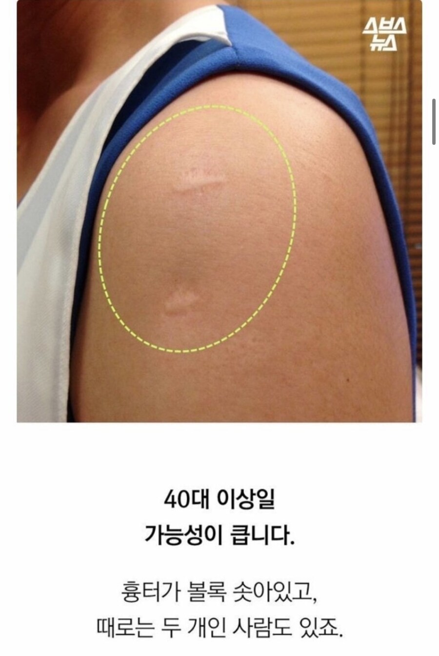 나잇대로 알수 있는 흉터들_2.jpg