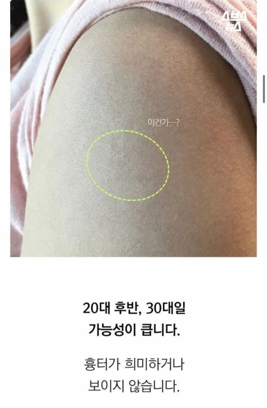 나잇대로 알수 있는 흉터들_3.jpg