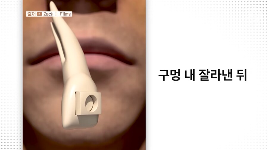 눈에 치아를 넣어 시력을 회복하는 수술_2.png