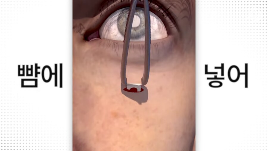 눈에 치아를 넣어 시력을 회복하는 수술_4.png