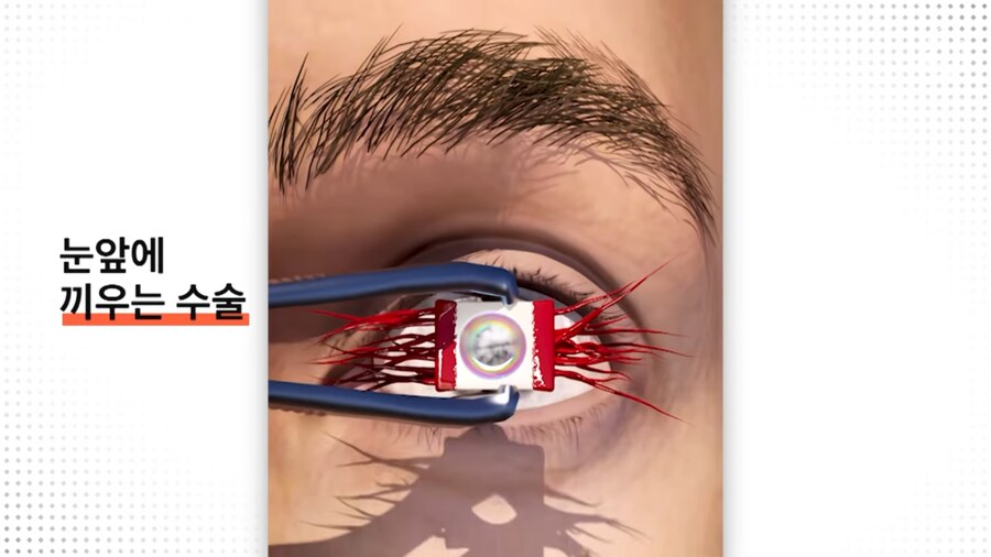 눈에 치아를 넣어 시력을 회복하는 수술_7.png