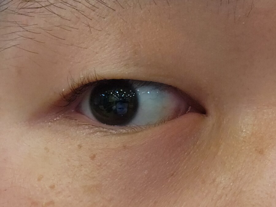 혐?) 눈에 뭐가 난 것 같아 안과 가 보니 다래끼라더라_1.jpg