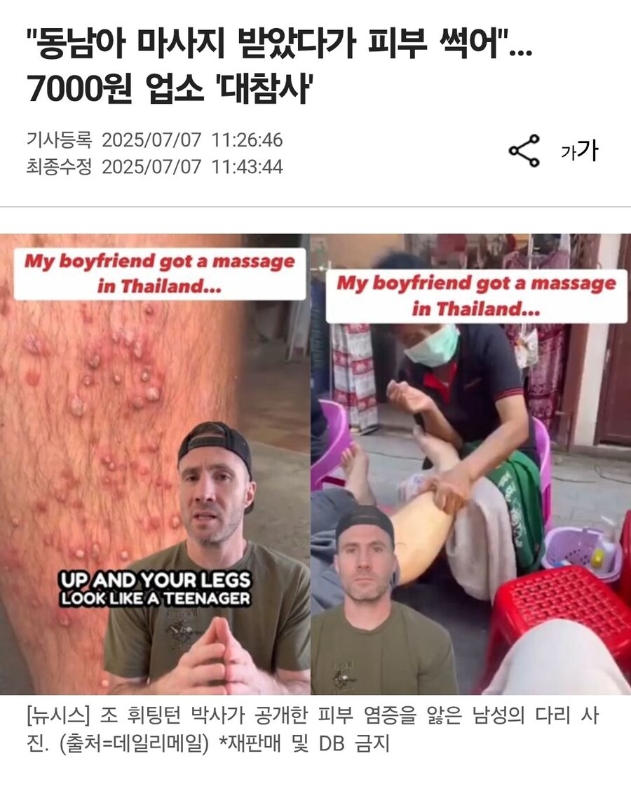 동남아 마사지 받았다가 피부썩어_1.jpg