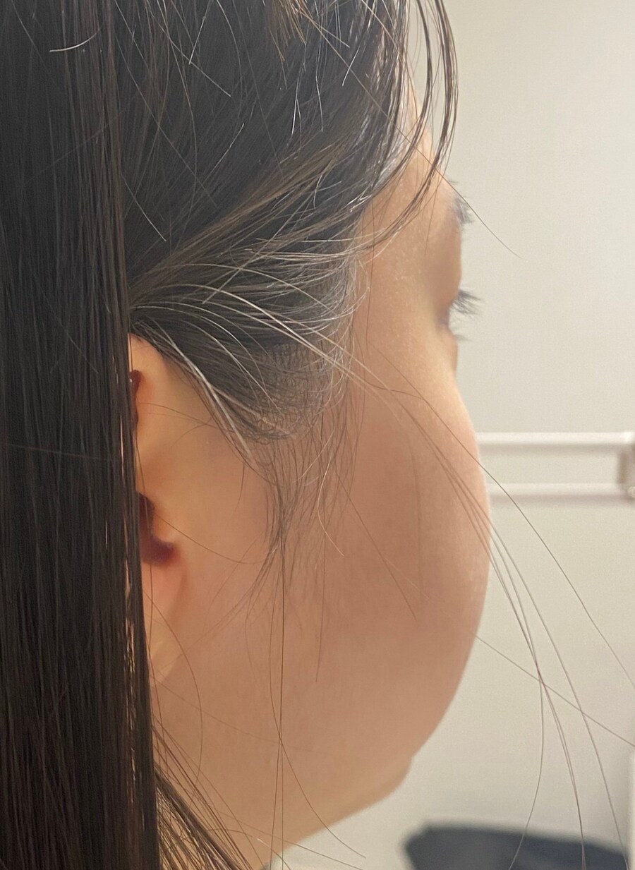 사랑니 4개 한번에 뽑은 썰 푸는 처자_4.jpg