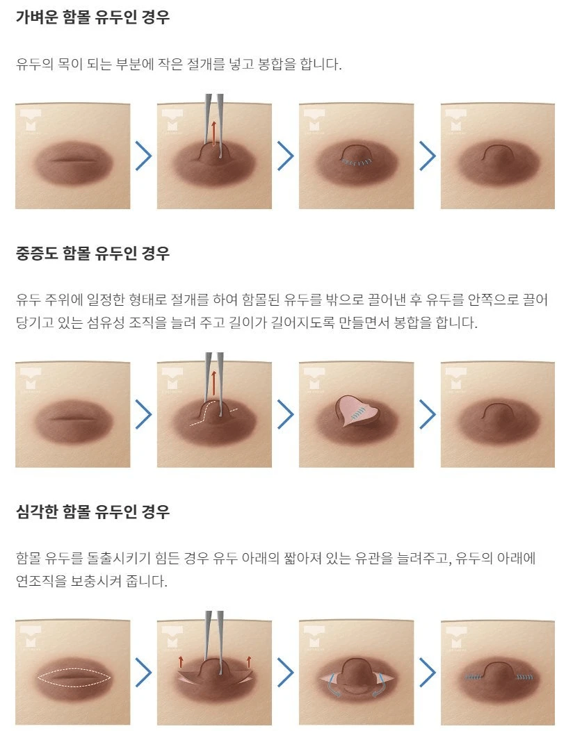 다양한 유두성형 기술.jpg_2.webp