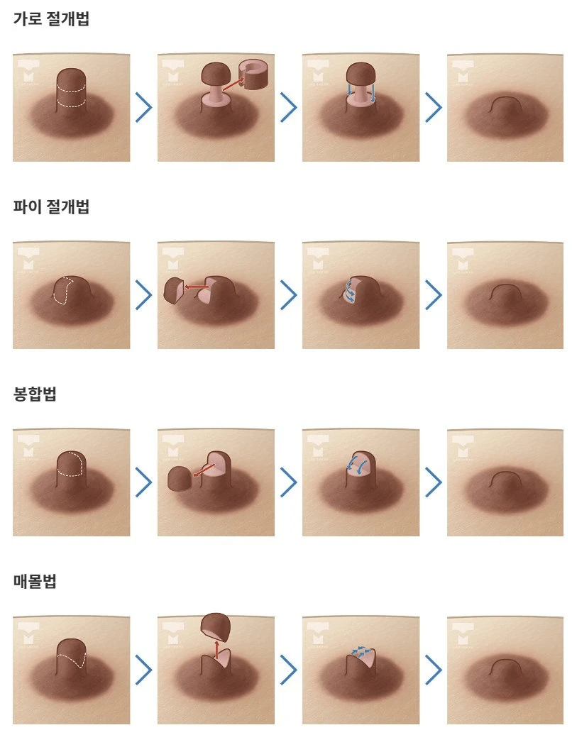 다양한 유두성형 기술.jpg_1.webp
