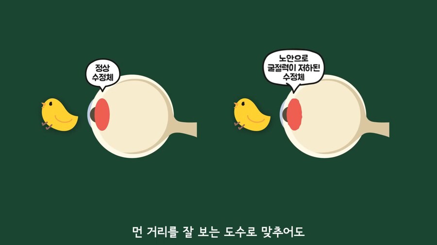 안과 의사들이 안경을 쓰는 이유.jpg_16.png