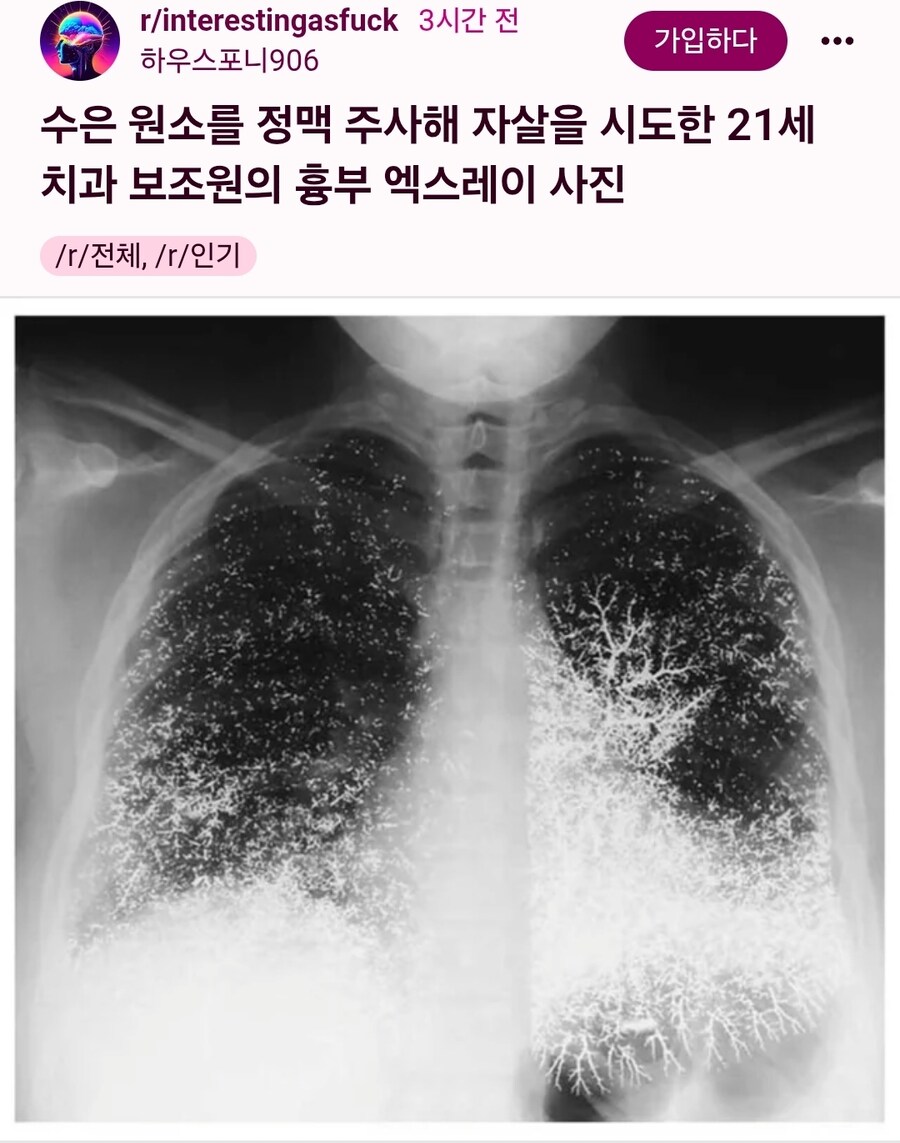 수은으로 자살시도한 여성의 흉부 엑스레이_1.jpg