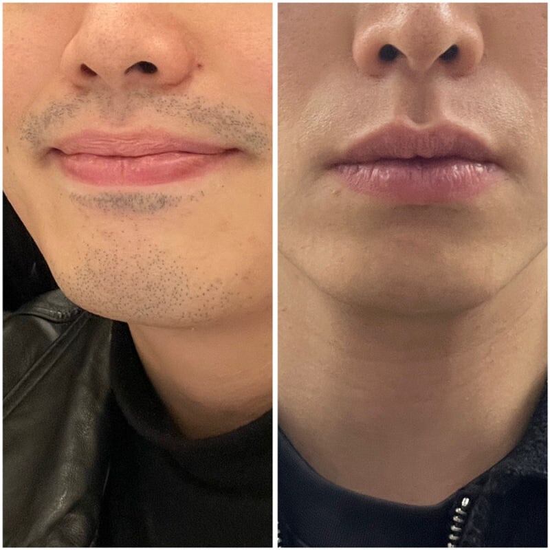 수염 레이저 제모_1.jpg