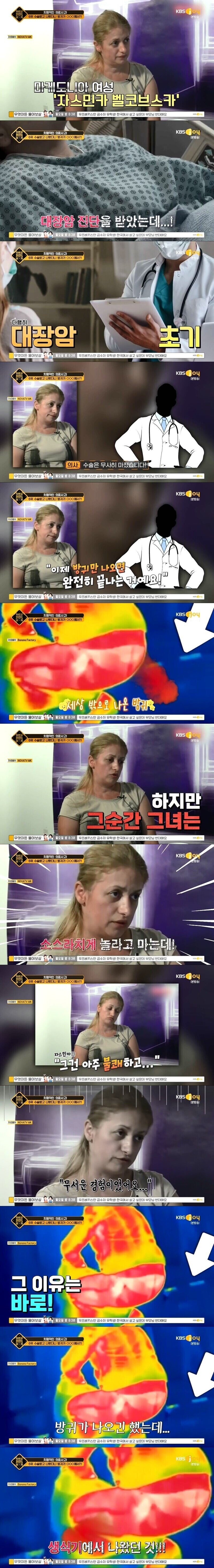 대장암 수술했더니 방귀가 다른곳에서 나온 여자_1.jpg