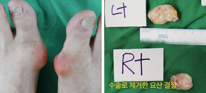 혐) 새벽을 일깨우는 내성발톱, 통풍, 사마귀_7.jpg