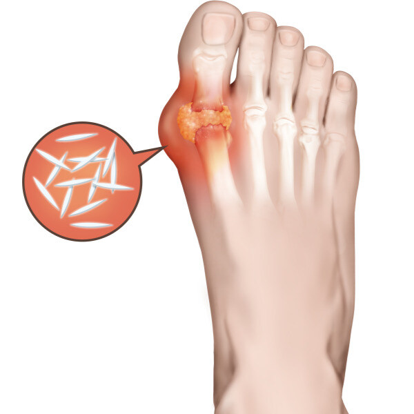 유게이들 나이 있으니 이제 통풍 이랑 당뇨 조심해야할듯_1.jpg