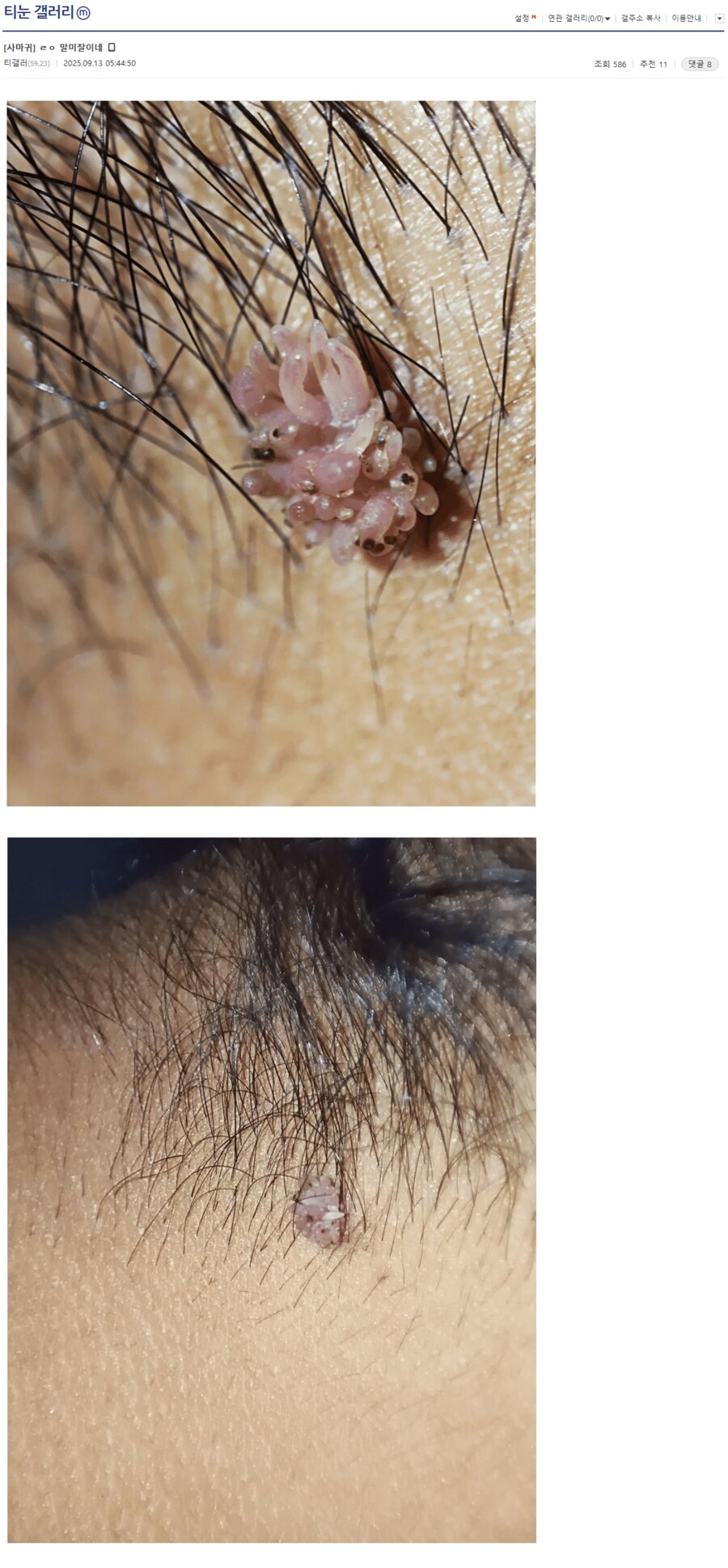 혐) 티눈갤 말미잘 등장_2.png