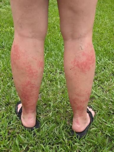 많은 미국인들이 디즈니에 가면 걸린다는병_2.jpg