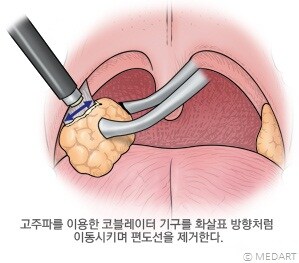 은근히 단점보다 장점이 많은 수술_1.jpg