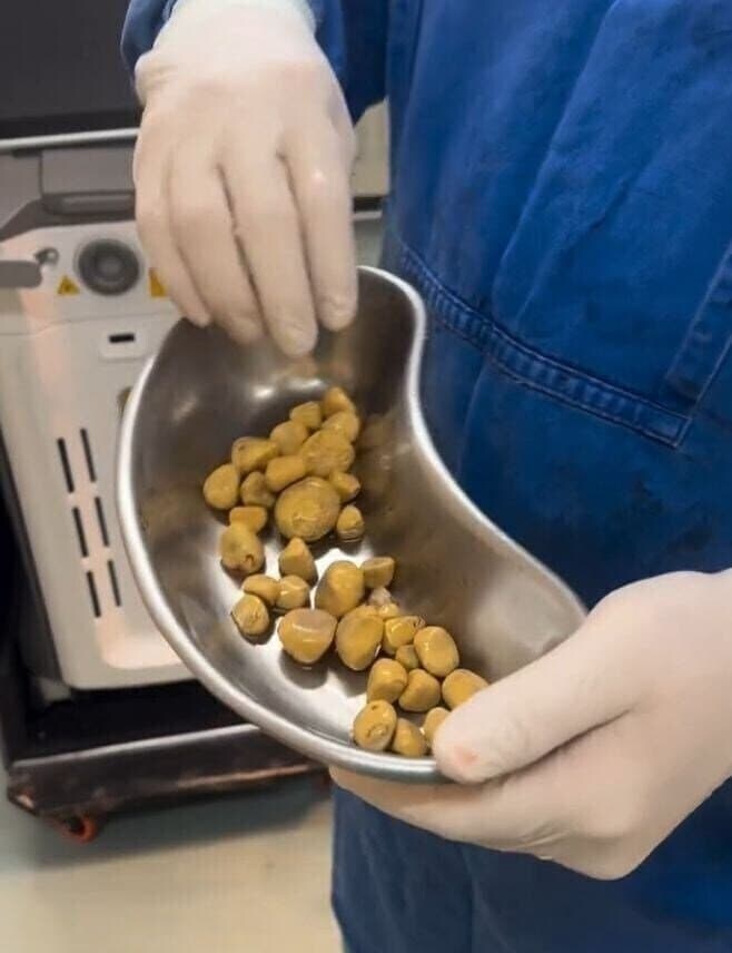 매일 물대신 콜라만 마신 60대 男_2.jpg