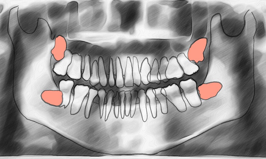 치과 다녀왔는데 사랑니 4개 있음_1.png