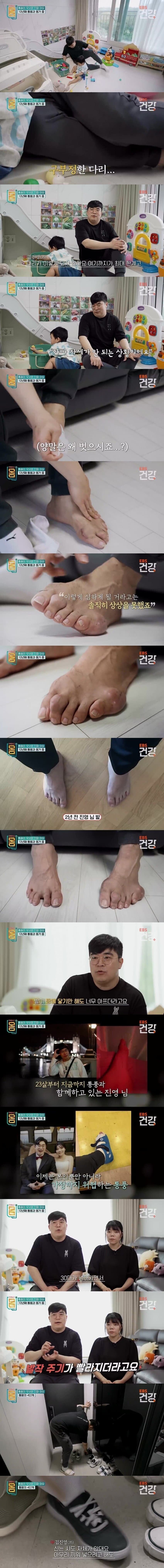 인터넷에 자주 돌아다니는 30대 통풍환자의 발.JPG짤의 진실_1.jpg