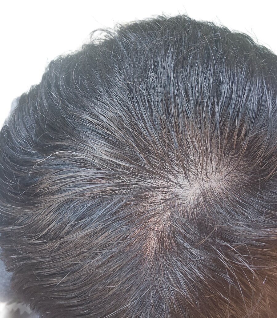 타코야키(진) 약 복용 1년 하고 4개월 경과_1.png