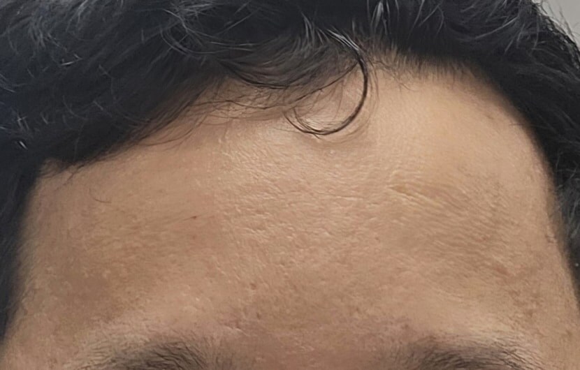 타코야키(진) 약 복용 1년 하고 4개월 경과_3.jpg