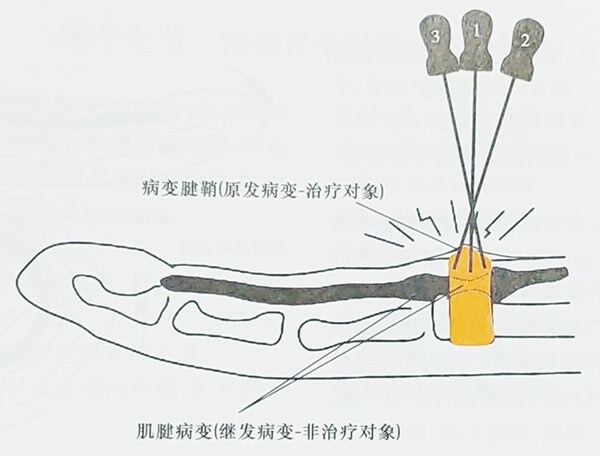 간단한 시술 같은거 집에서 셀프로 해도 될려나?_1.png