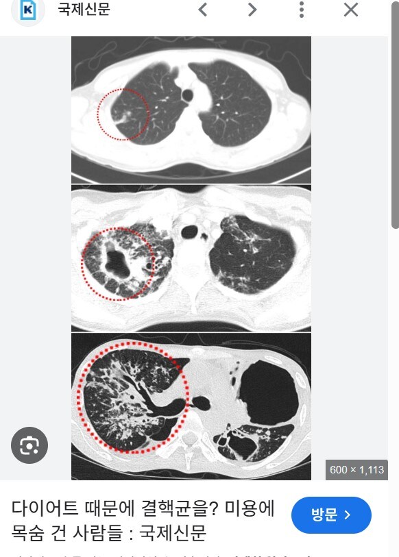 검증된 비만약(GLP1 제제) 등장으로 점차 사라지고 있는 것_3.jpg