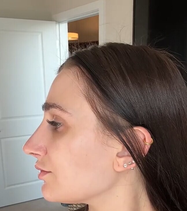 코 수술 전후 비교_3.jpg