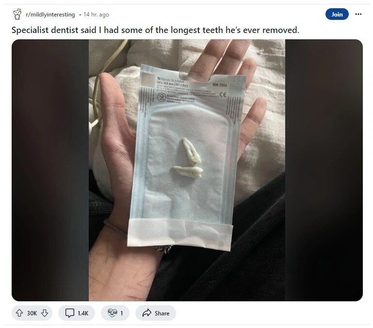 뽑은 이빨을 치과 의사가 기념으로 준 이유.JPG_1.webp