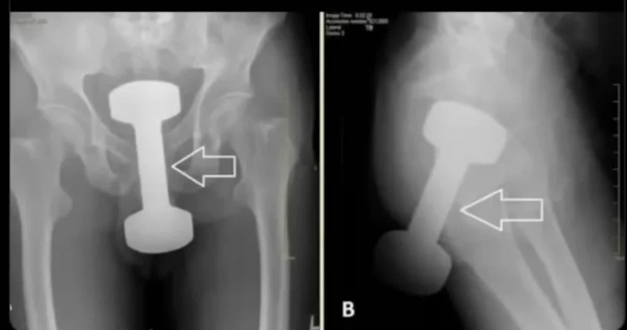 헬스장에서 아령을 깔고 앉지 마라는 이유._2.webp