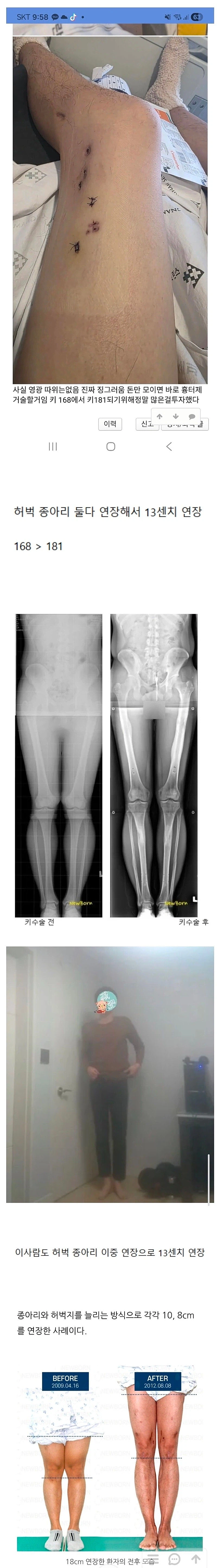 어마무시 하다는 키 13cm 연장술...ㅎㄷㄷ;;_1.webp