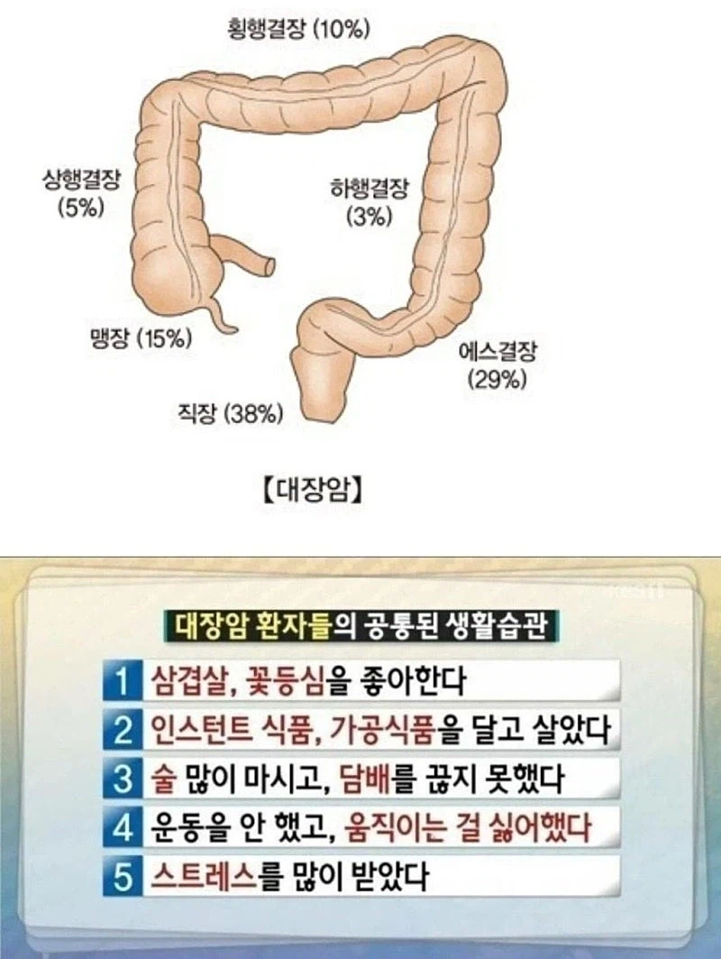 대장암 환자들의 공통된 생활습관.jpg_1.webp