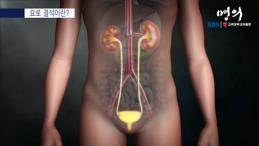 요로 결석이란?_2.webp