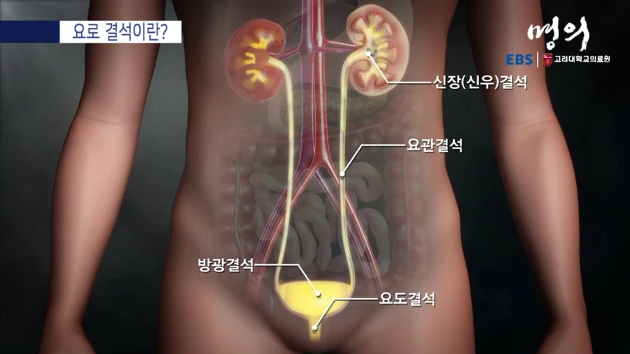 요로 결석이란?_4.webp