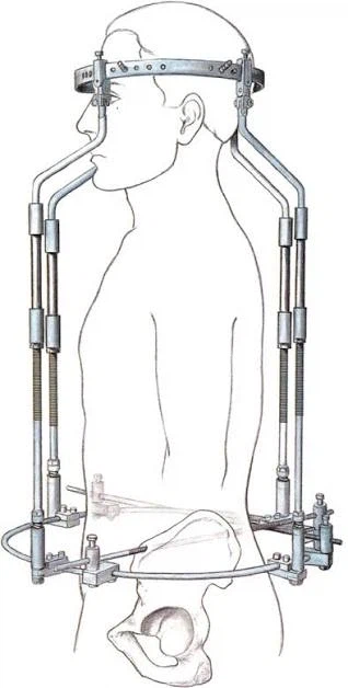 척추측만증이 심각한 어린이에게 이뤄지는 치료법_1.webp