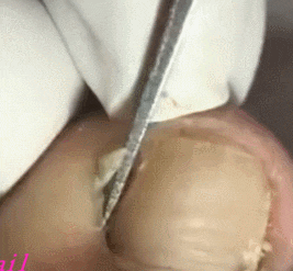 내성발톱 제거_1.gif