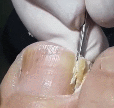 내성발톱 제거_2.gif