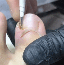 내성발톱 제거_5.gif