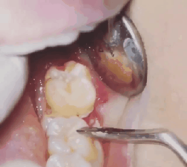 (혐짤주의)(실제 수술장면) 실제 사랑니 발치 하는 모습.GIF_1.gif