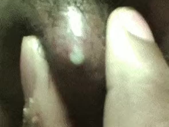 혐 피지낭종 압출 영상 모음
